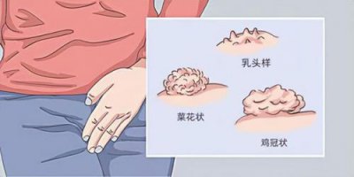 ​颗粒珍珠状疱疹 图片_颗粒珍珠状疱疹可以口吗