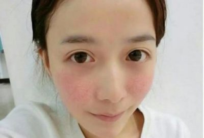 ​面部红血丝是什么原因？面部红血丝如何治疗