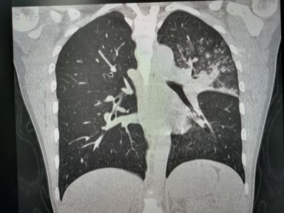 ​肺炎支原体肺炎首选抗生素(肺炎支原体肺炎突出的临床特点是)