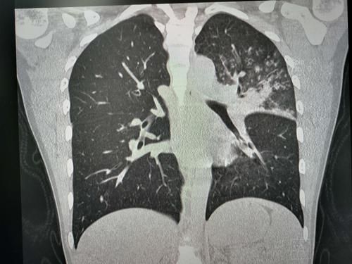 肺炎支原体肺炎首选抗生素(肺炎支原体肺炎突出的临床特点是)-第1张图片-