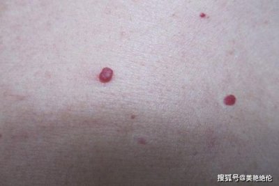 ​朱砂痣长什么样子手臂(朱砂痣长什么样代表什么意思)