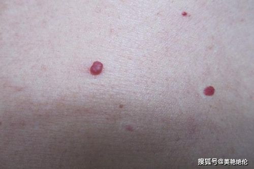 朱砂痣长什么样子手臂(朱砂痣长什么样代表什么意思)-第1张图片-