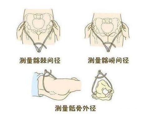 骨盆外测量的正常值有哪些？骨盆外测量哪几条径线及其正常值-第1张图片-