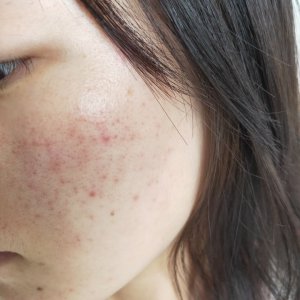 ​面部痤疮怎么治疗最彻底  ？