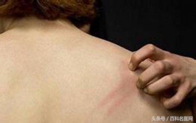 ​皮炎湿疹怎么治 春季皮肤瘙痒应该怎么办？