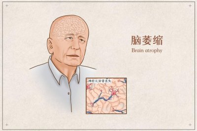 ​脑萎缩吃什么药好得快（老年人出现脑萎缩怎么办？服用3种药物，或能帮助改善