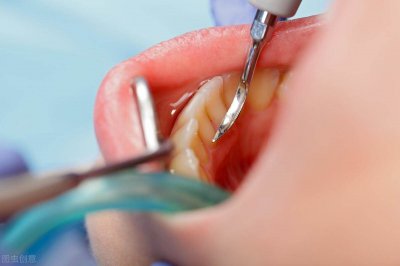 ​牙结石自己能处理吗视频 牙结石自己能处理吗多少钱