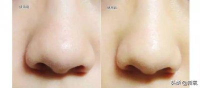 ​我把火爆全网的去黑头方法试了一遍，直接把最有效的告诉你