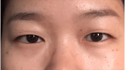 ​做个双眼皮要花1.5w元钱？为什么别人几百块就行？医生告诉您