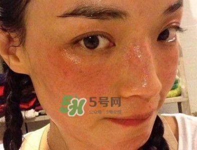 ​适合敏感肌用的护肤品 敏感肌适合用什么护肤品
