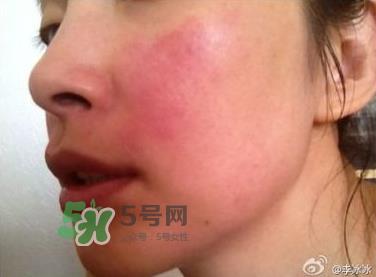 适合敏感肌用的护肤品 敏感肌适合用什么护肤品