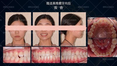 ​不拔牙案例 -隐适美不拔牙矫正，效果也很赞
