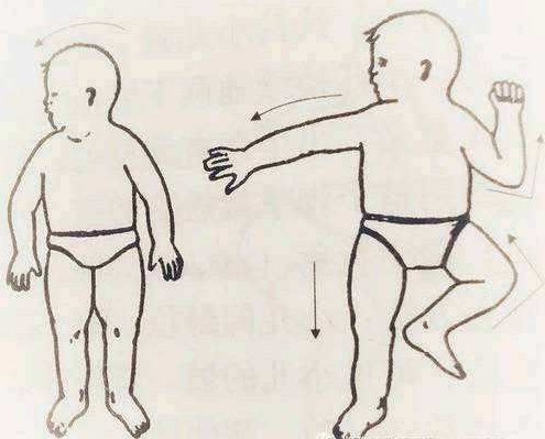 adl是什么意思（小儿脑性瘫痪的康复评估）