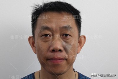 ​47岁，不顾反对去做眼袋手术，没想到把脸做成这样，太吓人了