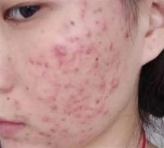 ​脸上长痘痘如何消除