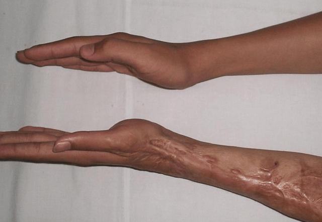 割肝救父真实案例（6年前13岁少年不顾劝阻）(4)