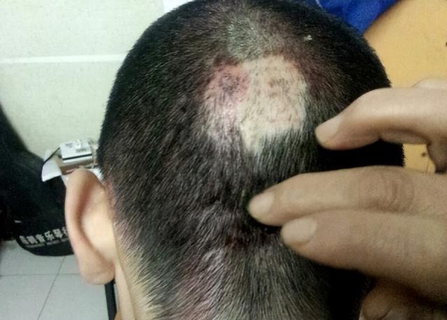 割肝救父真实案例（6年前13岁少年不顾劝阻）(10)