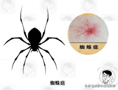 ​皮肤科普——蜘蛛痣